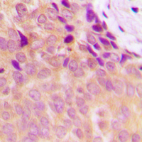 NDUFS5 Antibody - Immunohistochemical analysis of NDUFS5 staining in human breast cancer formalin fixed paraffin embedded tissue section. The section was pre-treated using heat mediated antigen retrieval with sodium citrate buffer (pH 6.0). The section was then incubated with the antibody at room temperature and detected using an HRP conjugated compact polymer system. DAB was used as the chromogen. The section was then counterstained with hematoxylin and mounted with DPX.