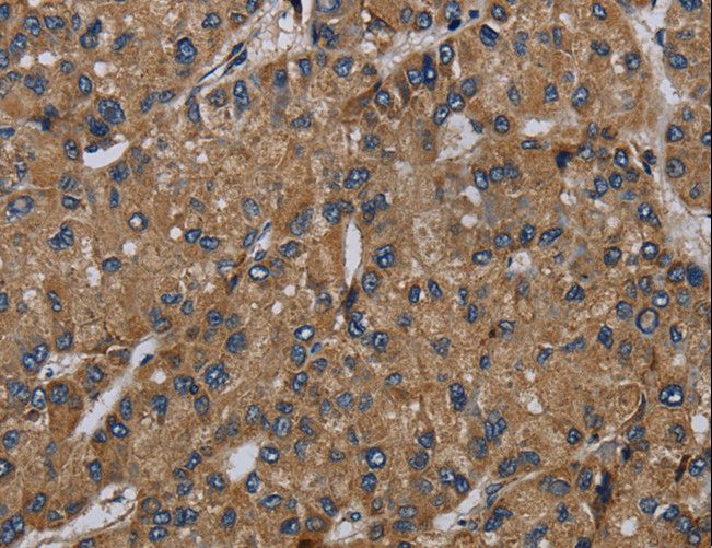 NDUFS6 Antibody - Immunohistochemistry of paraffin-embedded Human liver cancer using NDUFS6 Polyclonal Antibody at dilution of 1:50.