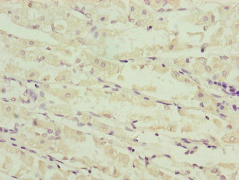 NDUFS6 Antibody - Immunohistochemistry of paraffin-embedded human gastric cancer at dilution of 1:100