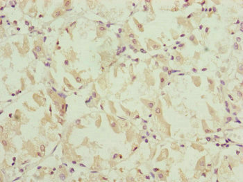 NDUFS6 Antibody - Immunohistochemistry of paraffin-embedded human gastric cancer at dilution of 1:100