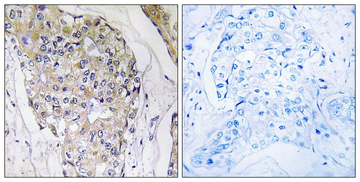 NDUFS6 Antibody - Peptide - + Immunohistochemistry analysis of paraffin-embedded human breast carcinoma tissue using NDUFS6 antibody.