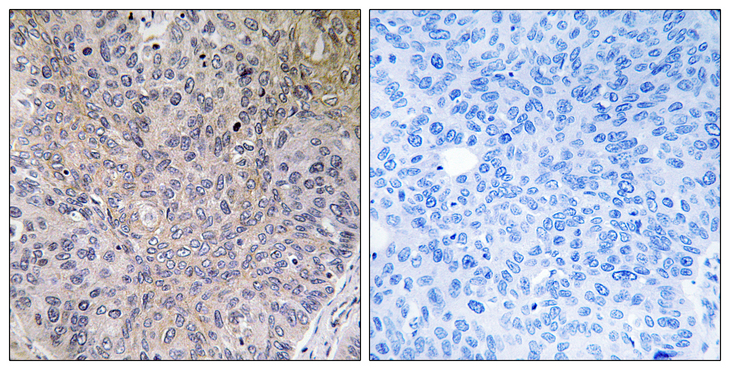 NDUFS7 Antibody - Immunohistochemistry analysis of paraffin-embedded human lung carcinoma tissue, using NDUFS7 Antibody. The picture on the right is blocked with the synthesized peptide.