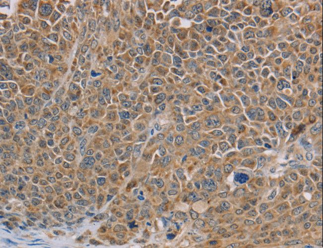 NDUFS7 Antibody - Immunohistochemistry of paraffin-embedded Human ovarian cancer using NDUFS7 Polyclonal Antibody at dilution of 1:40.