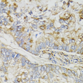 NDUFS7 Antibody - Immunohistochemistry of paraffin-embedded human gastric cancer tissue.