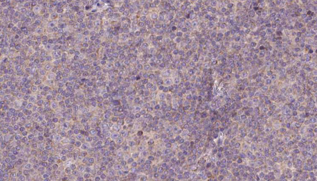 NDUFS7 Antibody - 1:100 staining human lymph carcinoma tissue by IHC-P. The sample was formaldehyde fixed and a heat mediated antigen retrieval step in citrate buffer was performed. The sample was then blocked and incubated with the antibody for 1.5 hours at 22°C. An HRP conjugated goat anti-rabbit antibody was used as the secondary.