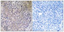 NDUFS7 Antibody - Peptide - + Immunohistochemistry analysis of paraffin-embedded human lung carcinoma tissue using NDUFS7 antibody.