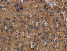 NDUFS8 Antibody - Immunohistochemistry of paraffin-embedded Human liver cancer using NDUFS8 Polyclonal Antibody at dilution of 1:50.
