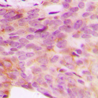 NDUFV3 Antibody - Immunohistochemical analysis of NDUFV3 staining in human breast cancer formalin fixed paraffin embedded tissue section. The section was pre-treated using heat mediated antigen retrieval with sodium citrate buffer (pH 6.0). The section was then incubated with the antibody at room temperature and detected using an HRP conjugated compact polymer system. DAB was used as the chromogen. The section was then counterstained with hematoxylin and mounted with DPX.