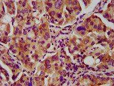 NEB / Nebulin Antibody - Immunohistochemistry image at a dilution of 1:600 and staining in paraffin-embedded human lung cancer performed on a Leica BondTM system. After dewaxing and hydration, antigen retrieval was mediated by high pressure in a citrate buffer (pH 6.0) . Section was blocked with 10% normal goat serum 30min at RT. Then primary antibody (1% BSA) was incubated at 4 °C overnight. The primary is detected by a biotinylated secondary antibody and visualized using an HRP conjugated SP system.