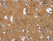 NECL-1 / CADM3 Antibody - Immunohistochemistry of paraffin-embedded Human colon cancer using CADM3 Polyclonal Antibody at dilution of 1:40.