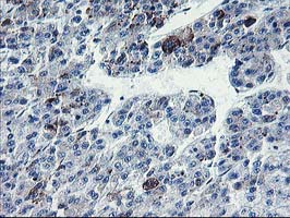 Nectin-1 / PVRL1 Antibody - IHC of paraffin-embedded Carcinoma of Human liver tissue using anti-PVRL1 mouse monoclonal antibody.