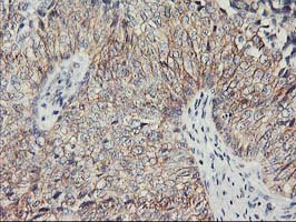 Nectin-1 / PVRL1 Antibody - IHC of paraffin-embedded Carcinoma of Human bladder tissue using anti-PVRL1 mouse monoclonal antibody.