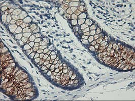 Nectin-1 / PVRL1 Antibody - IHC of paraffin-embedded Adenocarcinoma of Human ovary tissue using anti-PVRL1 mouse monoclonal antibody.
