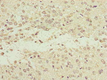 NEDD1 Antibody - Immunohistochemistry of paraffin-embedded human glioma cancer at dilution of 1:100
