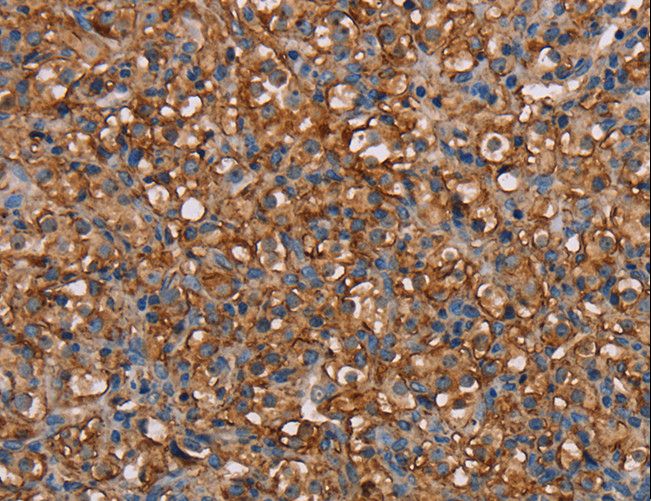 NEDD4L / NEDD4-2 Antibody - Immunohistochemistry of paraffin-embedded Human liver cancer using NEDD4L Polyclonal Antibody at dilution of 1:60.
