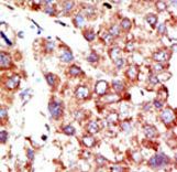 NEDD8 Antibody - Formalin-fixed and paraffin-embedded human cancer tissue reacted with the primary antibody, which was peroxidase-conjugated to the secondary antibody, followed by DAB staining. This data demonstrates the use of this antibody for immunohistochemistry; clinical relevance has not been evaluated. BC = breast carcinoma; HC = hepatocarcinoma.