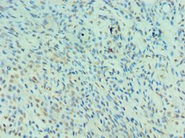 NEDD8 Antibody - Immunohistochemistry of paraffin-embedded human breast cancer using antibody at 1:100 dilution.