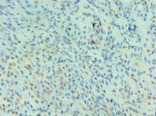NEDD8 Antibody - Immunohistochemistry of paraffin-embedded human breast cancer using antibody at 1:100 dilution.