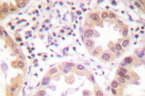 NEDD8 Antibody - IHC of NEDD8 (D21) pAb in paraffin-embedded human lung carcinoma tissue.