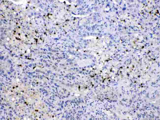 NEDD8 Antibody - NEDD8 was detected in paraffin-embedded sections of human lung cancer tissues using rabbit anti- NEDD8 Antigen Affinity purified polyclonal antibody