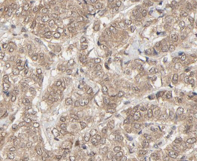 NEDD8 Antibody - IHC analysis of breast carcinoma tissue using NEDD8 antibody at 1:100