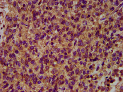 NEDL2 / HECW2 Antibody - Immunohistochemistry Dilution at 1:500 and staining in paraffin-embedded human glioma cancer performed on a Leica BondTM system. After dewaxing and hydration, antigen retrieval was mediated by high pressure in a citrate buffer (pH 6.0). Section was blocked with 10% normal Goat serum 30min at RT. Then primary antibody (1% BSA) was incubated at 4°C overnight. The primary is detected by a biotinylated Secondary antibody and visualized using an HRP conjugated SP system.