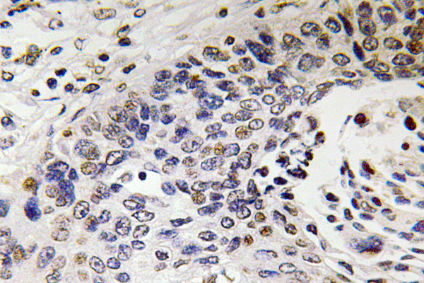 NEFH / NF-H Antibody - Immunohistochemistry analysis of NF-H antibody in paraffin-embedded human lung carcinoma tissue.