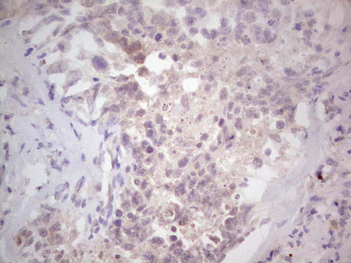 NEFM / NF-M Antibody - Immunohistochemical staining of paraffin-embedded Human testicular cancer tissue using anti-NEFM mouse monoclonal antibody. (Heat-induced epitope retrieval by 1 mM EDTA in 10mM Tris, pH8.5, 120C for 3min,