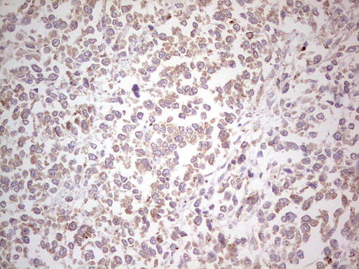 NEFM / NF-M Antibody - Immunohistochemical staining of paraffin-embedded Human melanoma tissue using anti-NEFM mouse monoclonal antibody. (Heat-induced epitope retrieval by 1 mM EDTA in 10mM Tris, pH8.5, 120C for 3min,