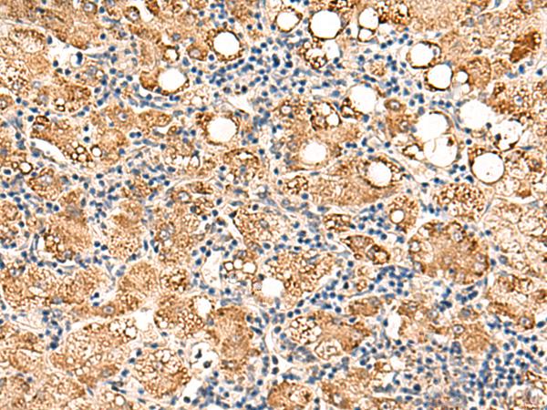 NEGR1 / Neurotractin Antibody - Immunohistochemistry of paraffin-embedded Human gastric cancer tissue  using NEGR1 Polyclonal Antibody at dilution of 1:50(×200)