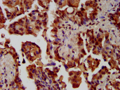 NEK1 Antibody - Immunohistochemistry image at a dilution of 1:300 and staining in paraffin-embedded human lung cancer performed on a Leica BondTM system. After dewaxing and hydration, antigen retrieval was mediated by high pressure in a citrate buffer (pH 6.0) . Section was blocked with 10% normal goat serum 30min at RT. Then primary antibody (1% BSA) was incubated at 4 °C overnight. The primary is detected by a biotinylated secondary antibody and visualized using an HRP conjugated SP system.