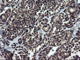 NEK11 Antibody - IHC of paraffin-embedded Carcinoma of Human thyroid tissue using anti-NEK11 mouse monoclonal antibody.