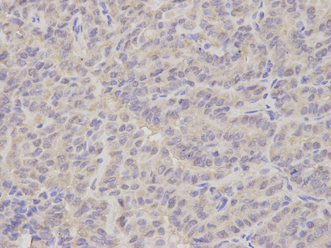 NEK2 Antibody - Immunohistochemistry of paraffin-embedded human kidney cancer using NEK2 antibody at dilution of 1:200 (400x lens).