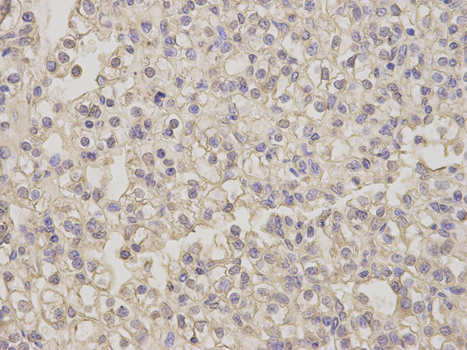 NEK2 Antibody - Immunohistochemistry of paraffin-embedded human thyroid cancer using NEK2 antibody at dilution of 1:200 (400x lens).