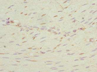 NEK3 Antibody - Immunohistochemistry of paraffin-embedded human colon cancer at dilution 1:100