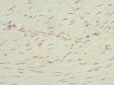 NEK3 Antibody - Immunohistochemistry of paraffin-embedded human colon cancer at dilution 1:100