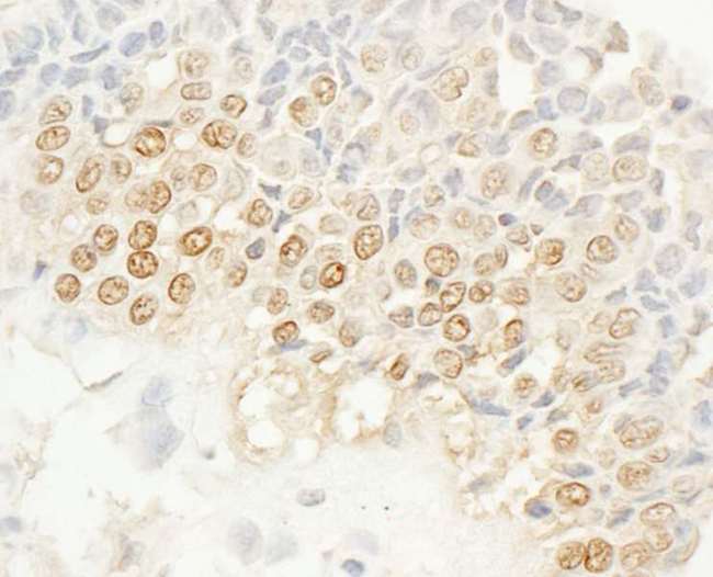 NEK4 Antibody - Detection of Human NEK4 by Immunohistochemistry. Sample: FFPE section of human breast carcinoma. Antibody: Affinity purified rabbit anti-NEK4 used at a dilution of 1:1000 (1 ug/ml). Detection: DAB.