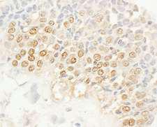 NEK4 Antibody - Detection of Human NEK4 by Immunohistochemistry. Sample: FFPE section of human breast carcinoma. Antibody: Affinity purified rabbit anti-NEK4 used at a dilution of 1:1000 (1 ug/ml). Detection: DAB.
