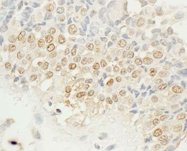NEK4 Antibody - Detection of Human NEK4 by Immunohistochemistry. Sample: FFPE section of human breast carcinoma. Antibody: Affinity purified rabbit anti-NEK4 used at a dilution of 1:200 (1 ug/ml). Detection: DAB.