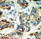 NEK4 Antibody - Formalin-fixed and paraffin-embedded human cancer tissue reacted with the primary antibody, which was peroxidase-conjugated to the secondary antibody, followed by AEC staining. This data demonstrates the use of this antibody for immunohistochemistry; clinical relevance has not been evaluated. BC = breast carcinoma; HC = hepatocarcinoma.