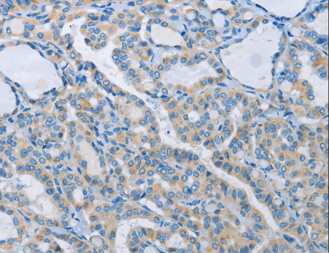 NEK5 Antibody - Immunohistochemistry of paraffin-embedded Human thyroid cancer using NEK5 Polyclonal Antibody at dilution of 1:60.