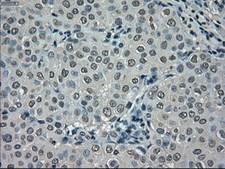 NEK6 Antibody - IHC of paraffin-embedded Adenocarcinoma of breast tissue using anti-NEK6 mouse monoclonal antibody. (Dilution 1:50).