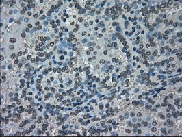 NEK6 Antibody - IHC of paraffin-embedded Carcinoma of kidney tissue using anti-NEK6 mouse monoclonal antibody. (Dilution 1:50).