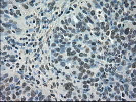 NEK6 Antibody - IHC of paraffin-embedded Adenocarcinoma of ovary tissue using anti-NEK6 mouse monoclonal antibody. (Dilution 1:50).