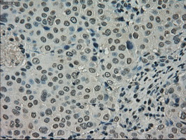 NEK6 Antibody - Immunohistochemical staining of paraffin-embedded Adenocarcinoma of breast tissue using anti-NEK6 mouse monoclonal antibody. (Dilution 1:50).