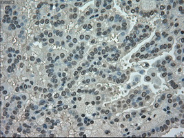 NEK6 Antibody - Immunohistochemical staining of paraffin-embedded Carcinoma of kidney tissue using anti-NEK6 mouse monoclonal antibody. (Dilution 1:50).