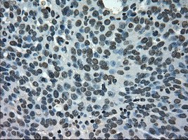 NEK6 Antibody - Immunohistochemical staining of paraffin-embedded Adenocarcinoma of ovary tissue using anti-NEK6 mouse monoclonal antibody. (Dilution 1:50).