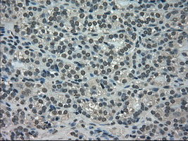 NEK6 Antibody - Immunohistochemical staining of paraffin-embedded Carcinoma of thyroid tissue using anti-NEK6 mouse monoclonal antibody. (Dilution 1:50).