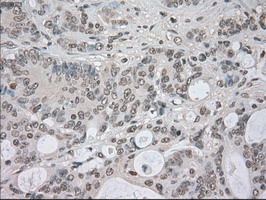 NEK6 Antibody - IHC of paraffin-embedded Adenocarcinoma of colon tissue using anti-NEK6 mouse monoclonal antibody. (Dilution 1:50).