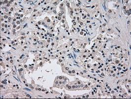 NEK6 Antibody - IHC of paraffin-embedded Carcinoma of prostate tissue using anti-NEK6 mouse monoclonal antibody. (Dilution 1:50).